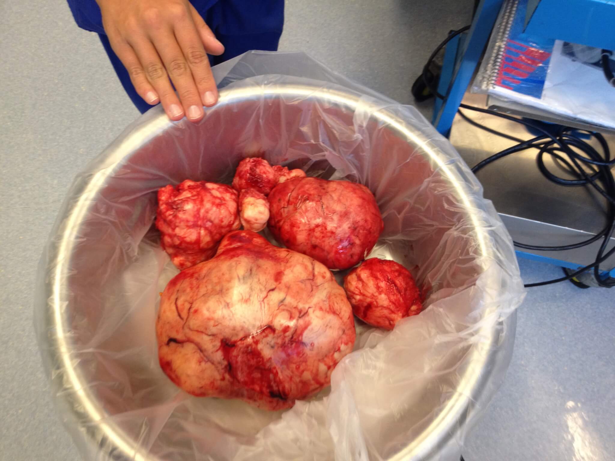 Fibroids after removal